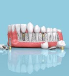 השתלת שיניים ממוחשבת או מודרכת מחשב – כל היתרונות-תמונה